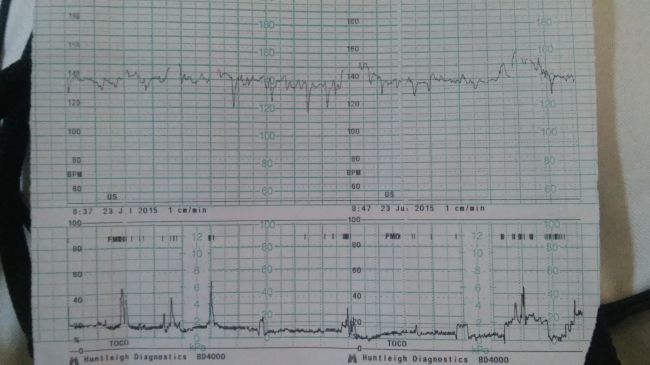 децелерация на ктг форум. что такое децелерация в ктг плода. что такое децелерация в ктг плода. ктг бланк. Stv 14 при ктг плода.