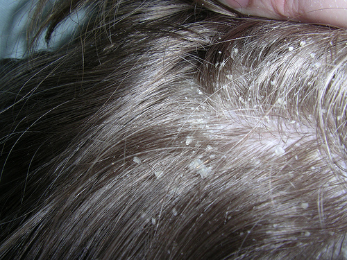 О чем может сигнализировать появление шелушений кожи головы у ребенка?