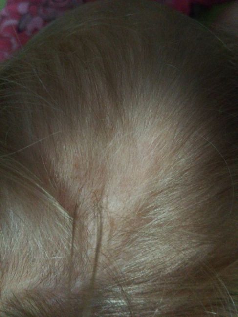 После грудного вскармливания выпали волосы. Выпадение волос у детей 8 месяцев. Ребенок 5 месяцев выпадают волосы. У ребёнка 5 лет выпадают волосы. Выпадение волос 5 месяцев ребенку.